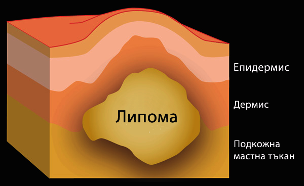 About Lipom BG: About Lipom BG (© Wellion)